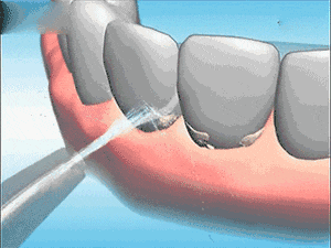 洗牙有什麼好处？为什麼医生都建议定期洗牙？