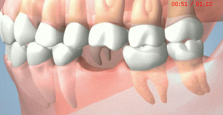 为什麼医生劝你把缺失的牙补起来？